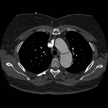 Aortic dissection (Radiopaedia 57969-64959 A 103).jpg