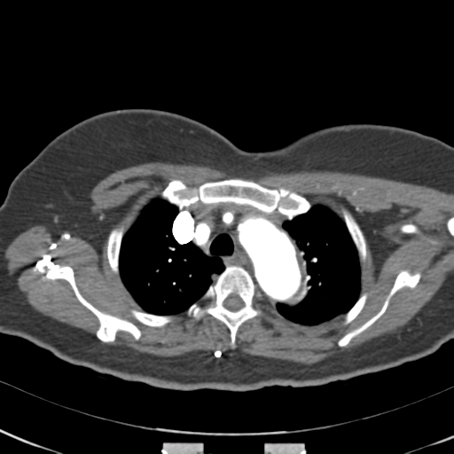 File:Aortic dissection - Stanford type A (Radiopaedia 39073-41259 A 17).png