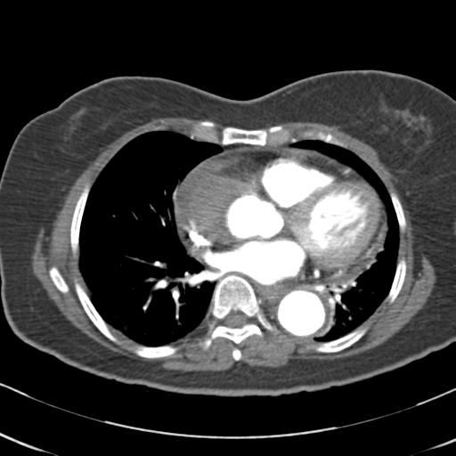 File:Aortic dissection - Stanford type A (Radiopaedia 39073-41259 A 46).png