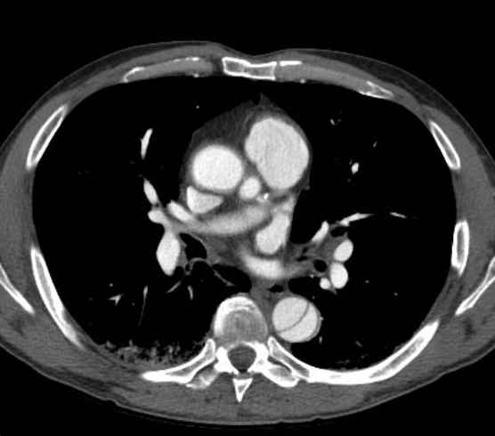 Aortic dissection - Stanford type B (Radiopaedia 73648-84437 A 53).jpg