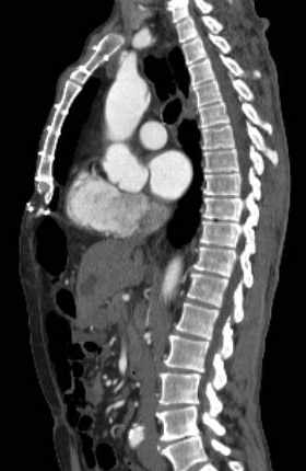 Aortic dissection - Stanford type B (Radiopaedia 73648-84437 C 81).jpg
