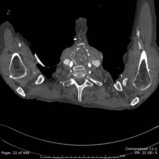 Aortic dissection with extension into aortic arch branches (Radiopaedia 64402-73204 B 22).jpg