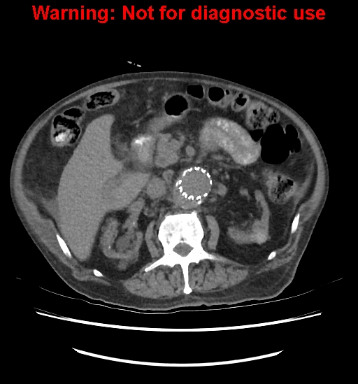 Aortic graft infection (Radiopaedia 44979-48907 Axial non-contrast 42).jpg