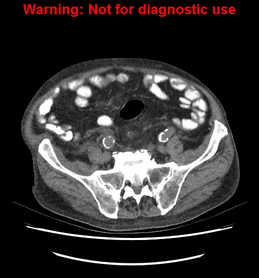 File:Aortic graft infection (Radiopaedia 44979-48907 Axial non-contrast 70).jpg