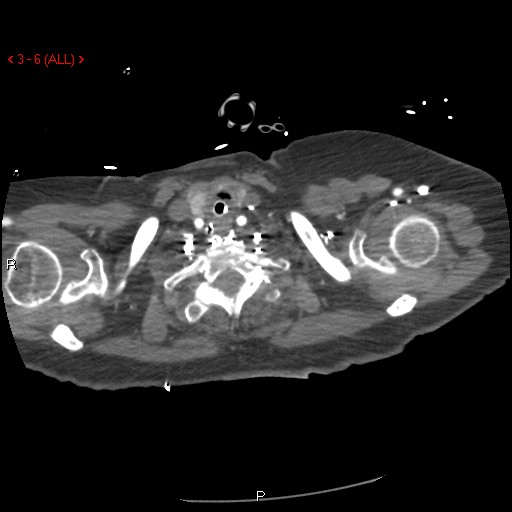 File:Aortic intramural hematoma (Radiopaedia 27746-28001 A 6).jpg