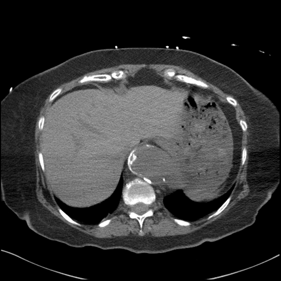 File:Aortic intramural hematoma with dissection and intramural blood pool (Radiopaedia 77373-89491 Axial non-contrast 85).jpg
