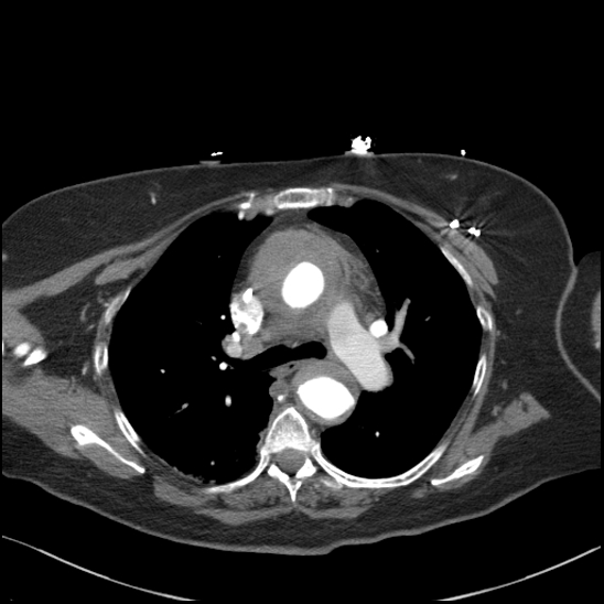 Aortic intramural hematoma with dissection and intramural blood pool (Radiopaedia 77373-89491 B 50).jpg