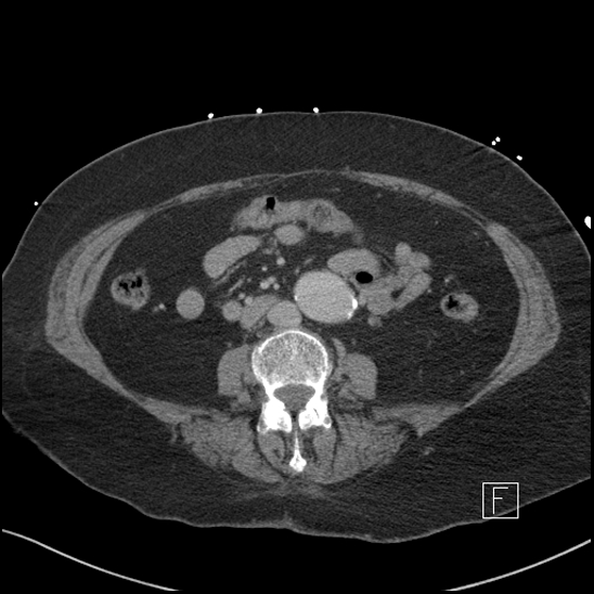 File:Aortic intramural hematoma with dissection and intramural blood pool (Radiopaedia 77373-89491 E 44).jpg