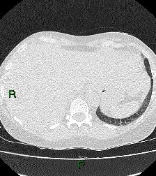 File:Aortic valve endocarditis (Radiopaedia 87209-103485 Axial lung window 87).jpg