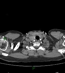 Aortic valve endocarditis (Radiopaedia 87209-103485 C 3).jpg