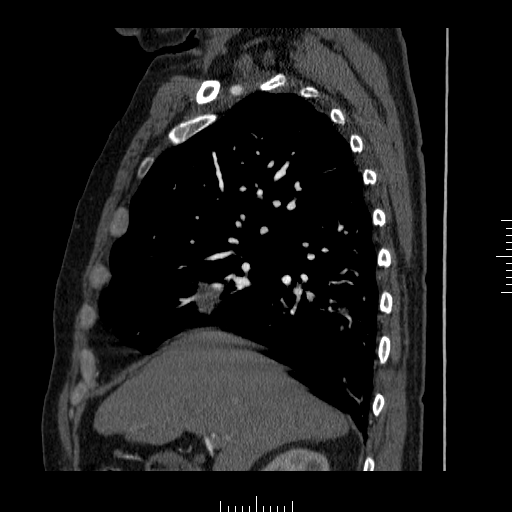 File:Aorto-coronary bypass graft aneurysms (Radiopaedia 40562-43157 C 5).png