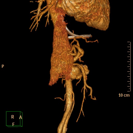 File:Aorto-left renal vein fistula (Radiopaedia 45534-49628 D 15).jpg