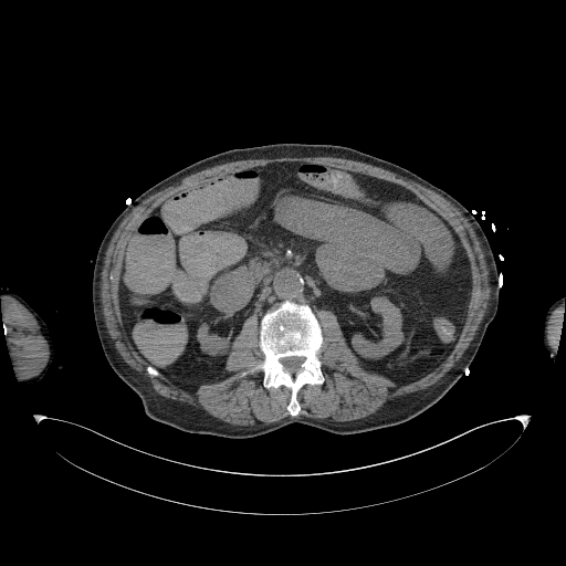 Aortoduodenal fistula (Radiopaedia 75286-86415 Axial non-contrast 29).jpg