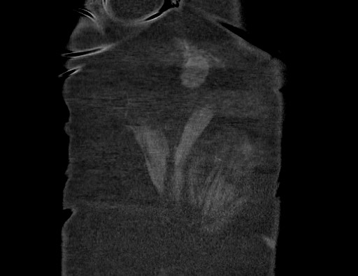 Aortoesophageal fistula with endovascular repair (Radiopaedia 73781-84592 Coronal C+ CTPA 140).jpg