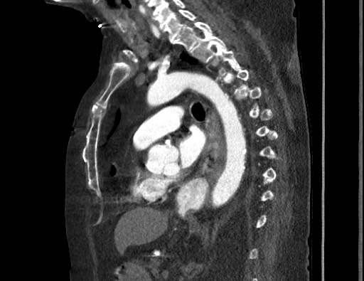 Aortoesophageal fistula with endovascular repair (Radiopaedia 73781-84592 Sagittal C+ CTPA 111).jpg
