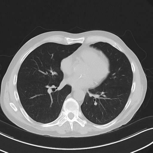 Apical pulmonary metastasis (Radiopaedia 46338-50754 Axial non-contrast 39).png
