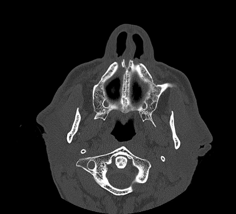 Aplastic maxillary sinuses (Radiopaedia 60030-67561 Axial non-contrast 15).jpg