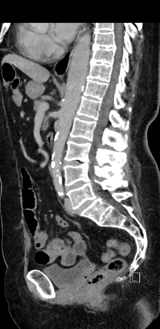 Appendiceal hemorrhage (Radiopaedia 70830-81025 Sagittal C+ delayed 59).jpg