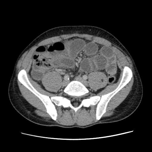 File:Appendicitis complicated by post-operative collection (Radiopaedia 35595-37114 A 59).jpg