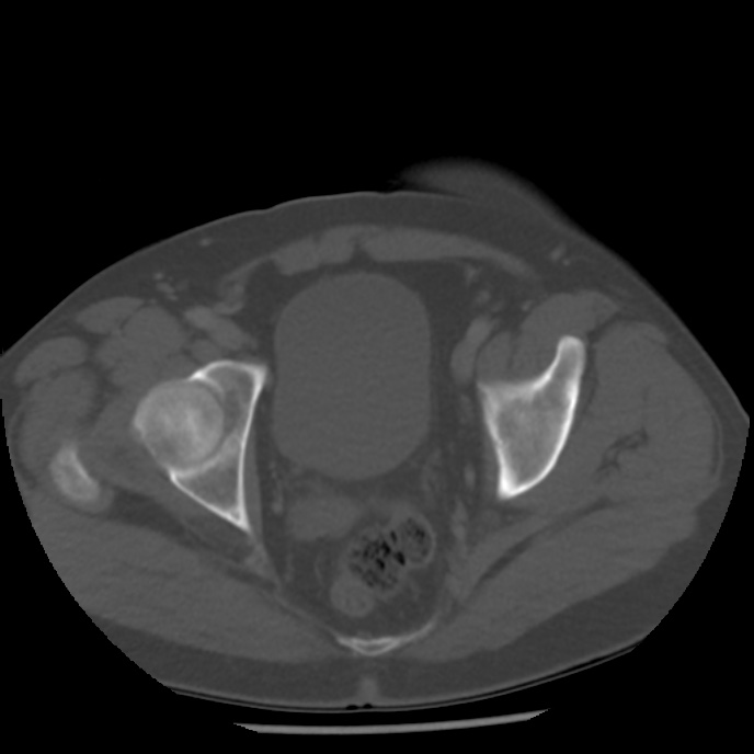 Appendicitis with perforation (Radiopaedia 35790-37342 Axial bone window 48).jpg