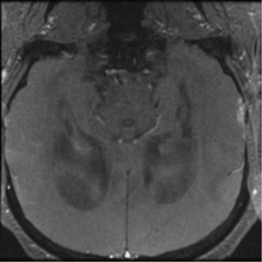 File:Aqueduct stenosis with corpus callosum hypoattenuation post shunting (Radiopaedia 37212-38969 Axial CSF Flow 51).png