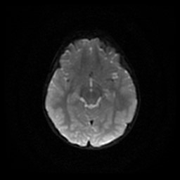 Arachnoid cyst - middle cranial fossa (Radiopaedia 86780-102938 Axial DWI 46).jpg