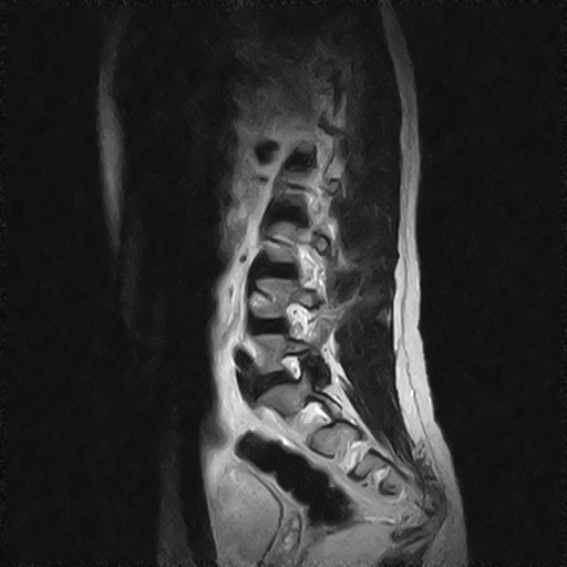 File:Arachnoid cyst - spinal (Radiopaedia 66835-76157 Sagittal T2 10).jpg
