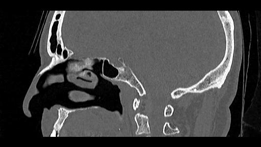 Arcuate foramen (Radiopaedia 89833-106944 Sagittal bone window 46).jpg