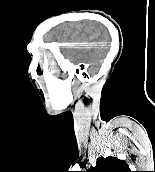 Arrow injury to the brain (Radiopaedia 72101-82607 H 18).jpg