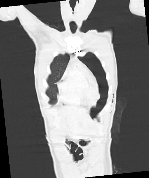 Arrow injury to the chest (Radiopaedia 85367-100975 Coronal lung window 45).jpg
