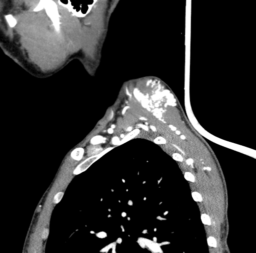 Arteriovenous malformation of the neck (Radiopaedia 53935-60062 C 15).jpg