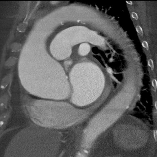File:Ascending aortic aneurysm (Radiopaedia 20913-20846 A 15).jpg