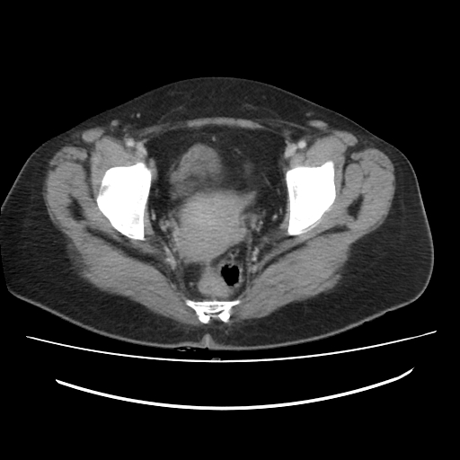 Ascending retrocecal appendicitis with liver abscesses (Radiopaedia 60066-67615 B 82).jpg