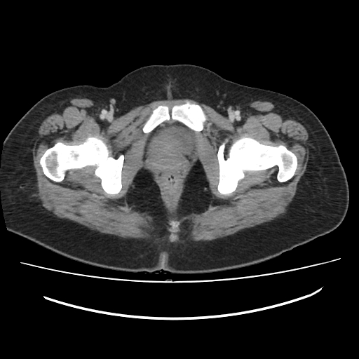 File:Ascending retrocecal appendicitis with liver abscesses (Radiopaedia 60066-67615 B 90).jpg