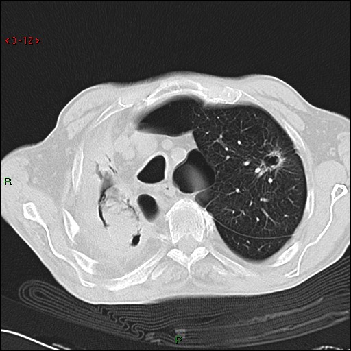 File:Aspergilloma (Radiopaedia 14842-14787 Axial lung window 12).jpg