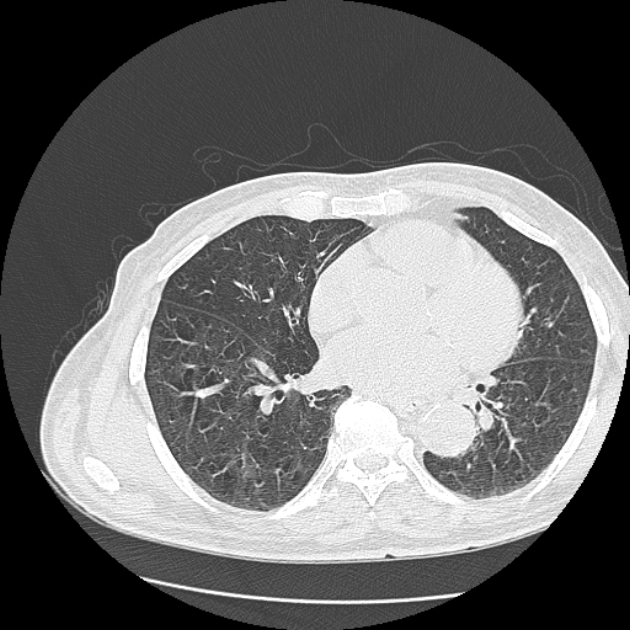 Aspergilloma (Radiopaedia 44592-48327 Axial lung window 55).jpg