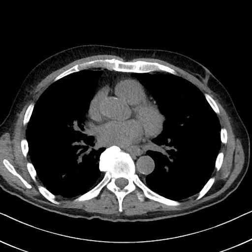 Aspergilloma on background pulmonary fibrosis (Radiopaedia 60942-68757 Axial non-contrast 34).jpg