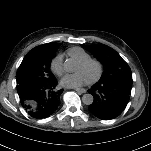 Aspergilloma on background pulmonary fibrosis (Radiopaedia 60942-68757 Axial non-contrast 36).jpg