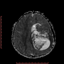 Astroblastoma (Radiopaedia 74287-85162 Axial ADC 46).jpg