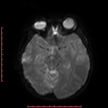 Astroblastoma (Radiopaedia 74287-85162 Axial DWI 36).jpg