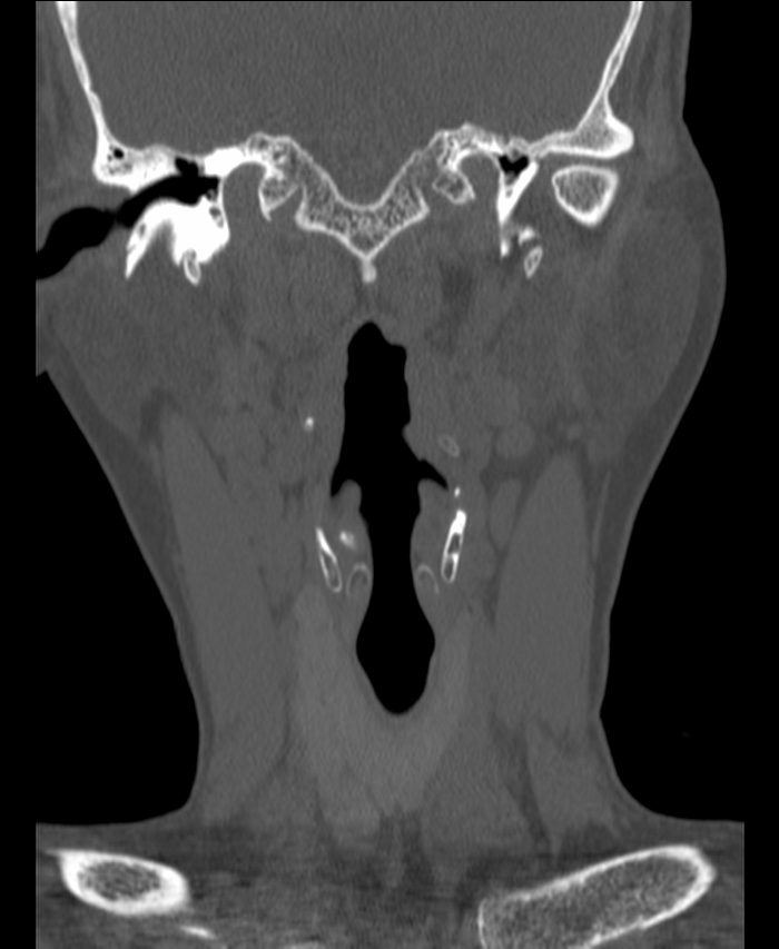 Atlanto-occipital assimilation with basilar invagination (Radiopaedia 70122-80188 Coronal bone window 27).jpg