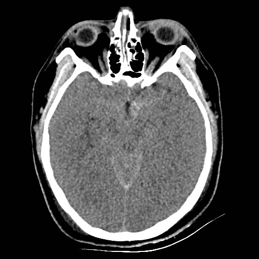 Atlanto-occipital dislocation (Radiopaedia 44648-48412 Axial non-contrast 23).jpg