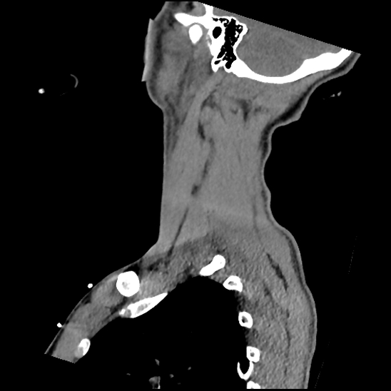 File:Atlanto-occipital dissociation (Traynelis type 1), C2 teardrop fracture, C6-7 facet joint dislocation (Radiopaedia 87655-104061 D 68).jpg