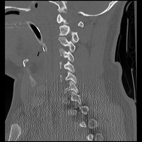 Atlanto-occipital dissociation injury (Radiopaedia 29274-29698 Sagittal bone window 23).png