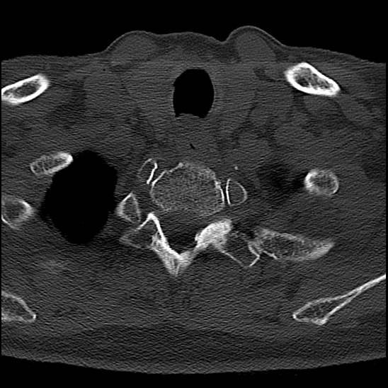 File:Atlas (type 3b subtype 1) and axis (Anderson and D'Alonzo type 3, Roy-Camille type 2) fractures (Radiopaedia 88043-104607 Axial bone window 72).jpg
