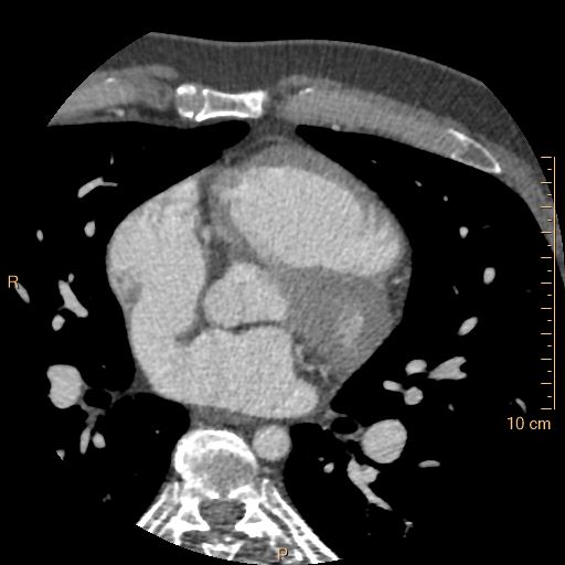 Atrial septal defect (upper sinus venosus type) with partial anomalous pulmonary venous return into superior vena cava (Radiopaedia 73228-83961 A 116).jpg