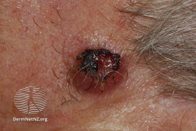 File:Atypical fibroxanthoma (DermNet NZ lesions-afx).jpg