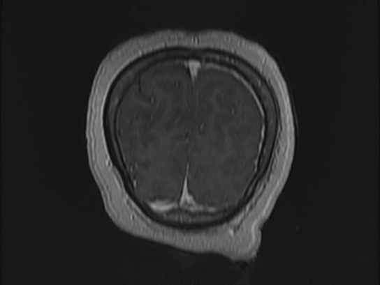 Atypical meningioma (Radiopaedia 62985-71406 Coronal T1 C+ 118).jpg