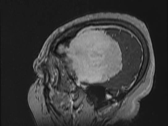 Atypical meningioma (Radiopaedia 62985-71406 Sagittal T1 C+ 85).jpg