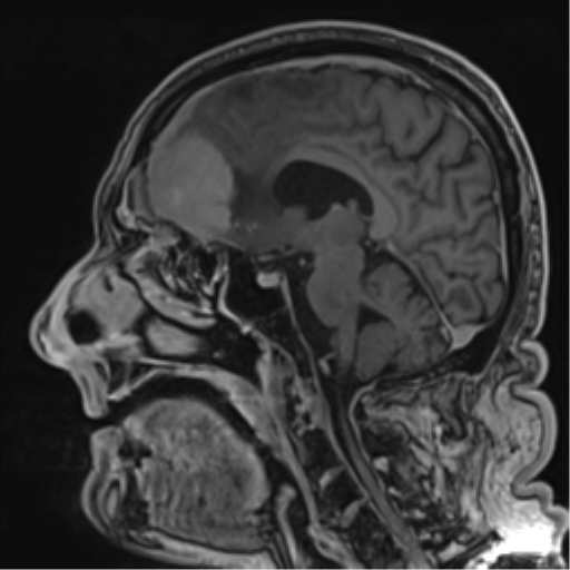 Atypical meningioma (WHO grade II) with brain invasion (Radiopaedia 57767-64729 Sagittal T1 C+ 38).png
